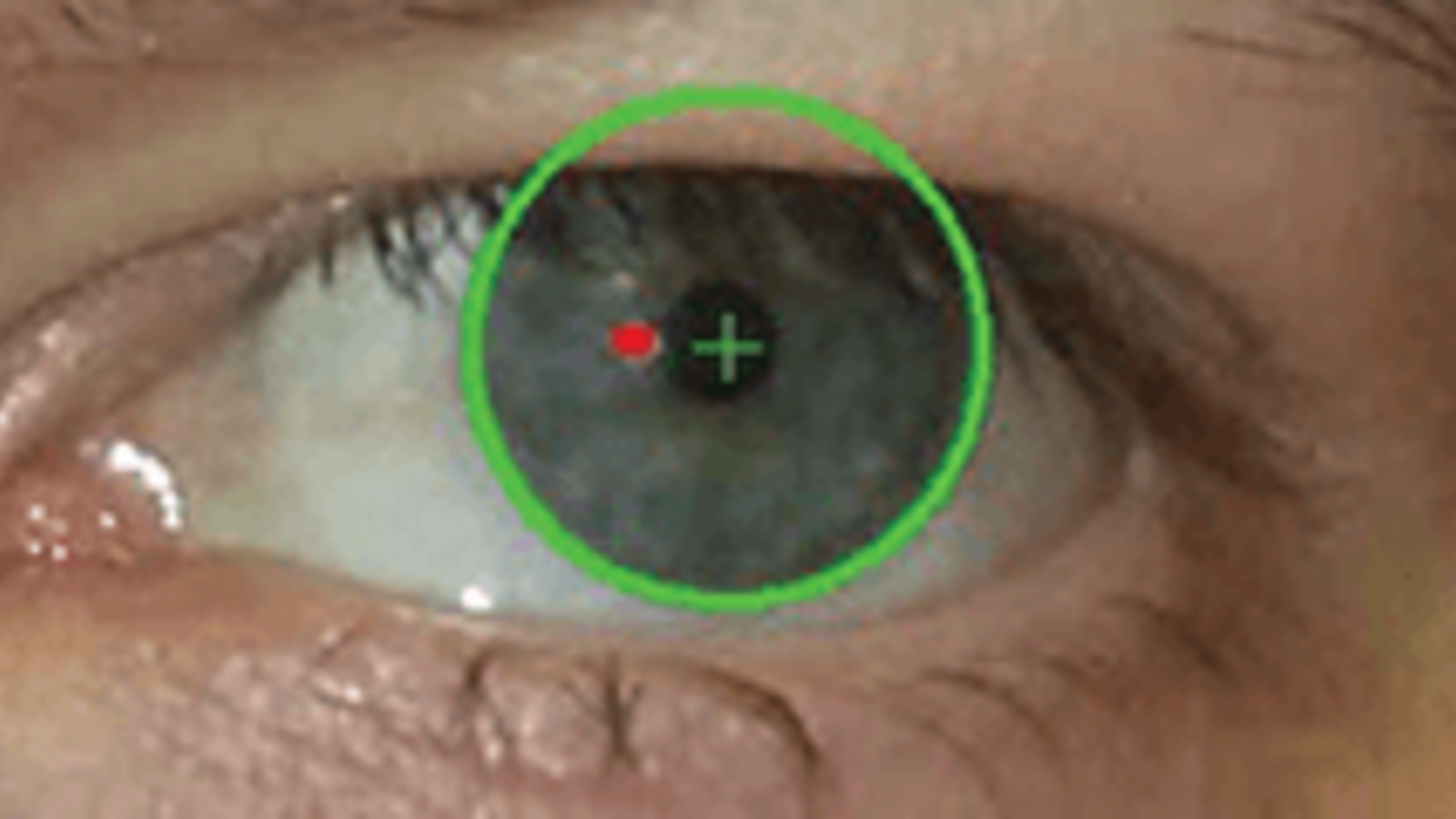 Strabismus Screening Now There S An App For That