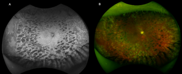 Which is less painful: argon‐microchip technology or frequency doubled ...