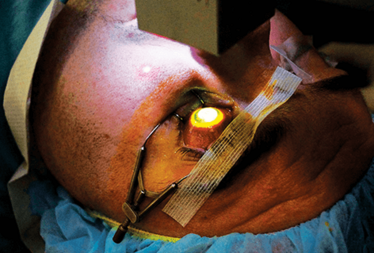 Figure 2. Patient undergoing the corneal cross-linking procedure