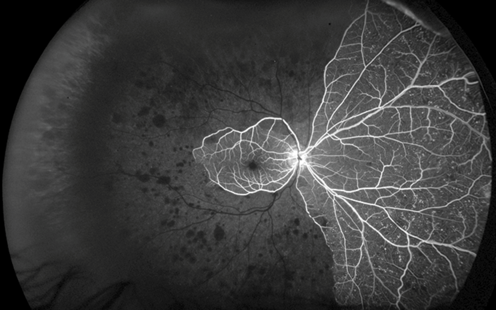 Optimizing Patient Management With Ultra Widefield Retinal Imaging