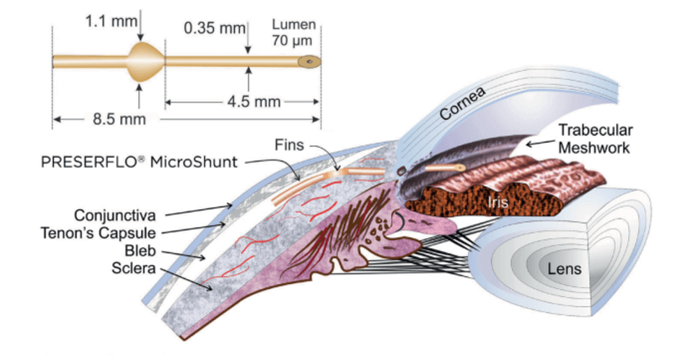 PRESERFLO: Consistent Glaucoma Surgery Outcomes