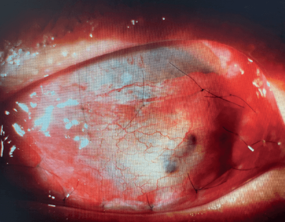 Image Of The Month Gundersen Conjunctival Hooding Flap