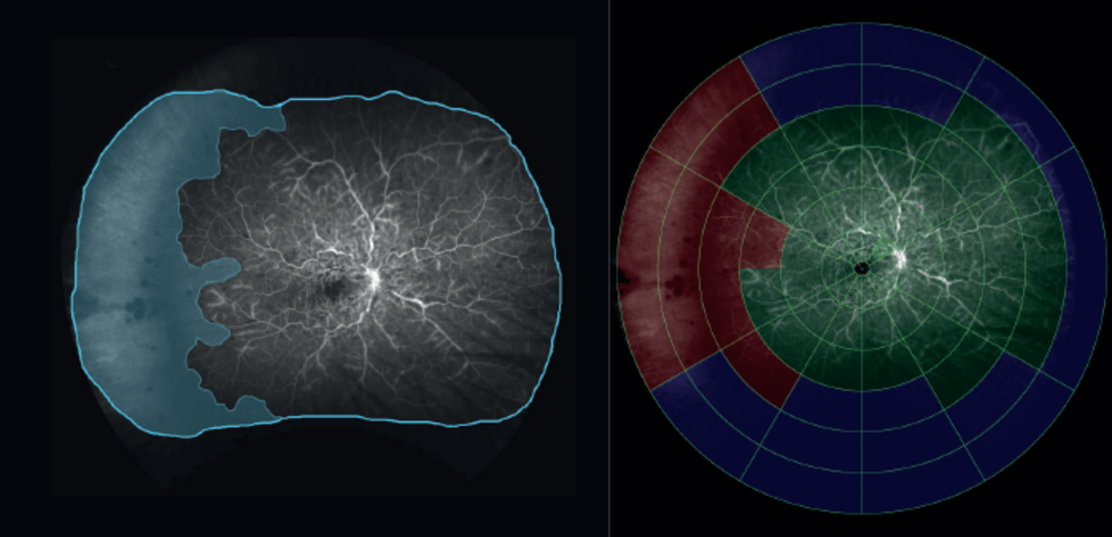 Retinal Imaging: The Big Picture