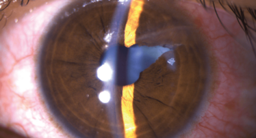 would, iris laceration and traumatic cataract caused by foreign