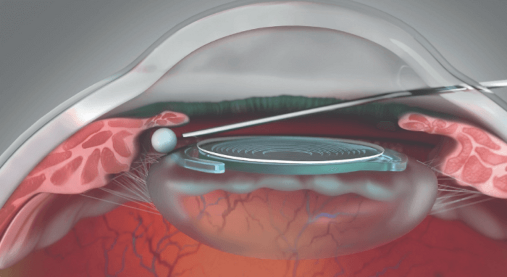 Dousing the Post-Cataract Flames