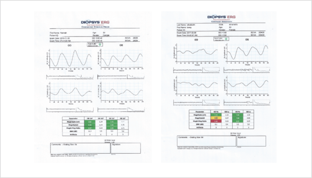 Shifting Patterns In Glaucoma Management - 