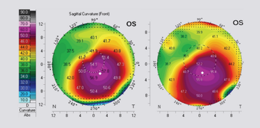 Figure 4. Pre-operative Pentacam image (A) and 1 year post- corneal cross-linking image  (B). 