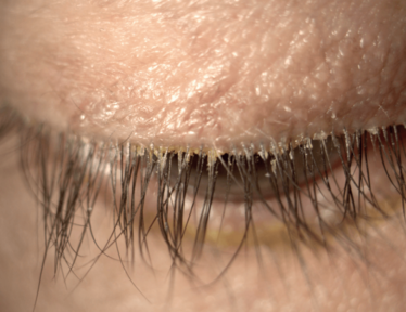 Ed Holland Asks If Demodex Blepharitis Treatment Is The Next Big Thing ...