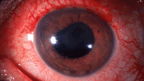 0425-015-AI-news-Cancer-Therapy-Uveitis.png