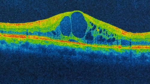 0525-Time-Machine-26-Cystoid-Macular-Edema.png