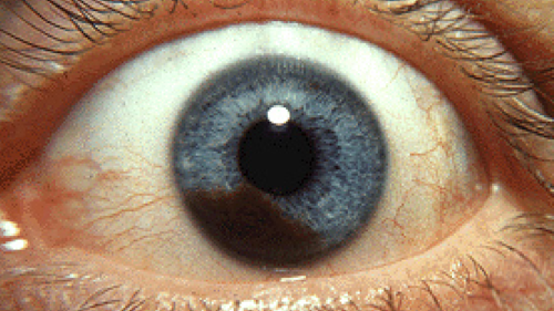 0525-006-AI-News-Evaluating-Melphalan-HDS.png